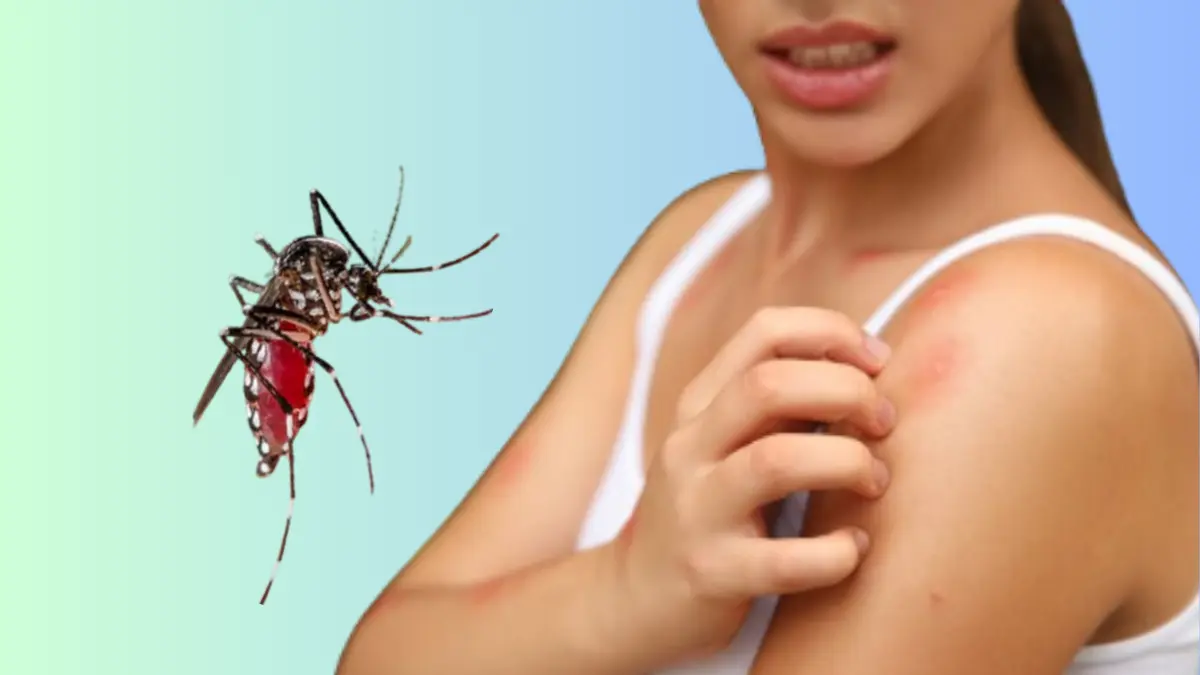 Itching in Dengue Is Good or Bad